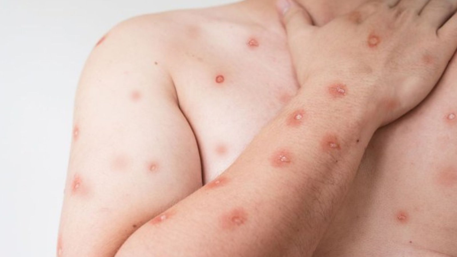 Image do post Caso de Mpox é confirmado no Sul do Brasil enquanto autoridades reforçam vigilância sanitária