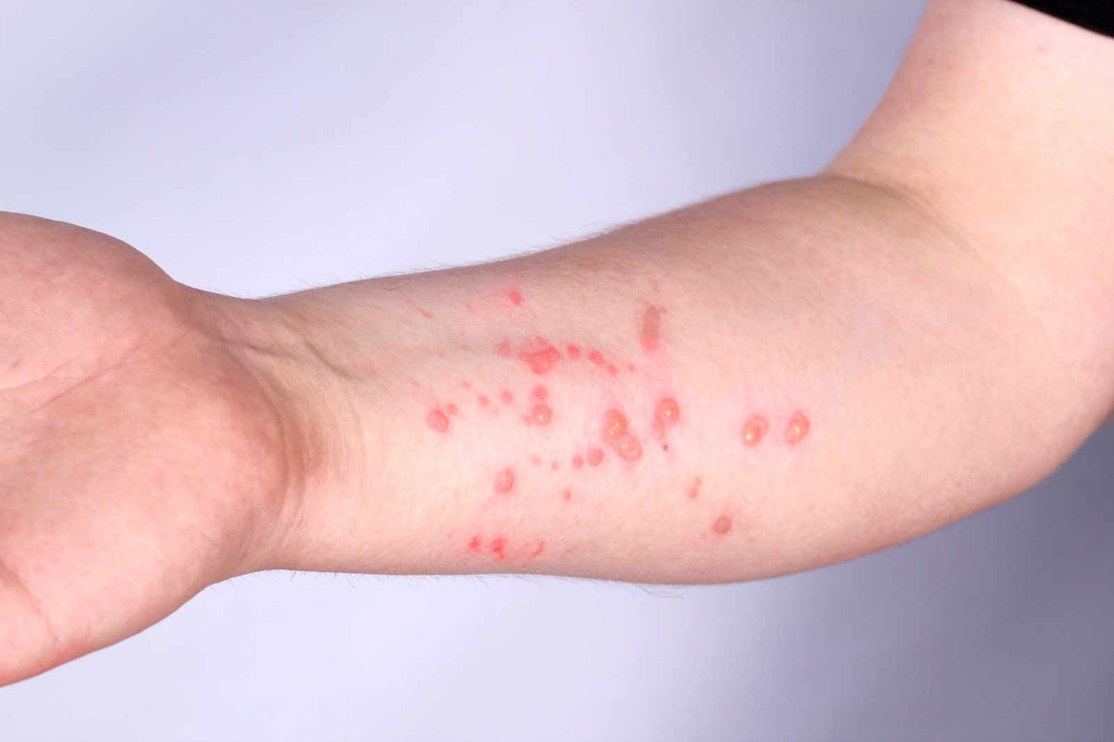 Image do post MPOX NO BRASIL: 13 ESTADOS REGISTRAM CASOS EM 2026 E AUTORIDADES REFORÇAM VIGILÂNCIA