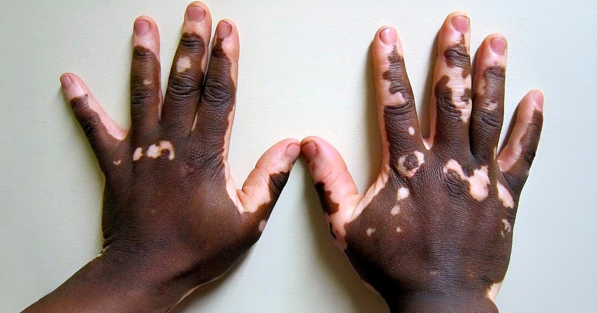 Image do post Pesquisas apontam novas estratégias para o tratamento do vitiligo com nanotecnologia e terapia gênica